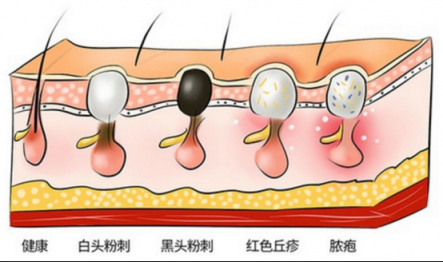 讓黑頭乖乖跑出來，黑頭儀有用嗎？