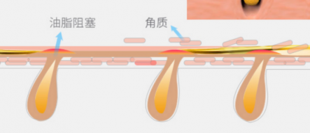 一百種去黑頭的方法都失敗了？去黑頭攻略全部拿下！