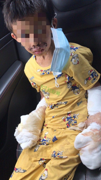 生命接力！輕松籌上愛心匯聚，幫助被生父燒傷的可憐男童重獲新生