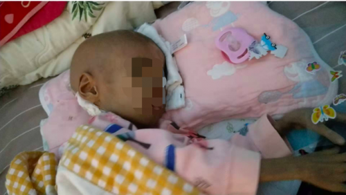 4歲女童得罕見病只有11斤，高昂費用壓垮母親，水滴愛心接力帶來希望