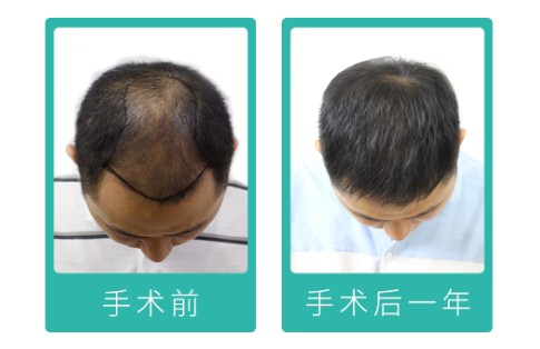 90后“禿”然崛起，常州新生植發(fā)：3D植發(fā)技術(shù)備受關(guān)注