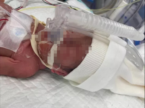 孩子剛出生就住進ICU，水滴籌筑起生命長城