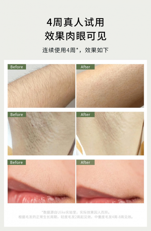 秋冬獼猴桃，夏天水煮蛋，在家脫毛選Ulike藍(lán)寶石冰點(diǎn)脫毛儀