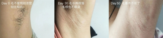 女生也會長胡子長臉毛？Ulike脫毛儀攜手丁香醫(yī)生為你解秘